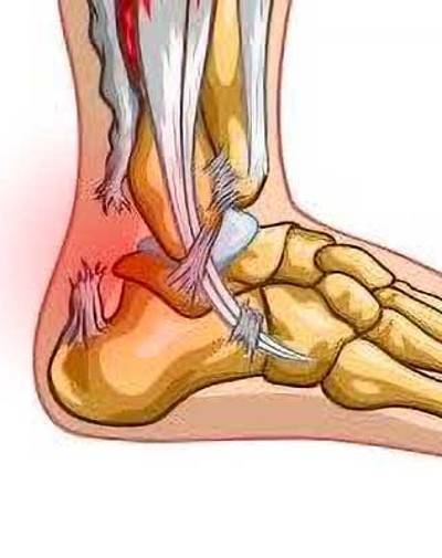 Illustration anatomique d'une rupture du tendon d'Achille