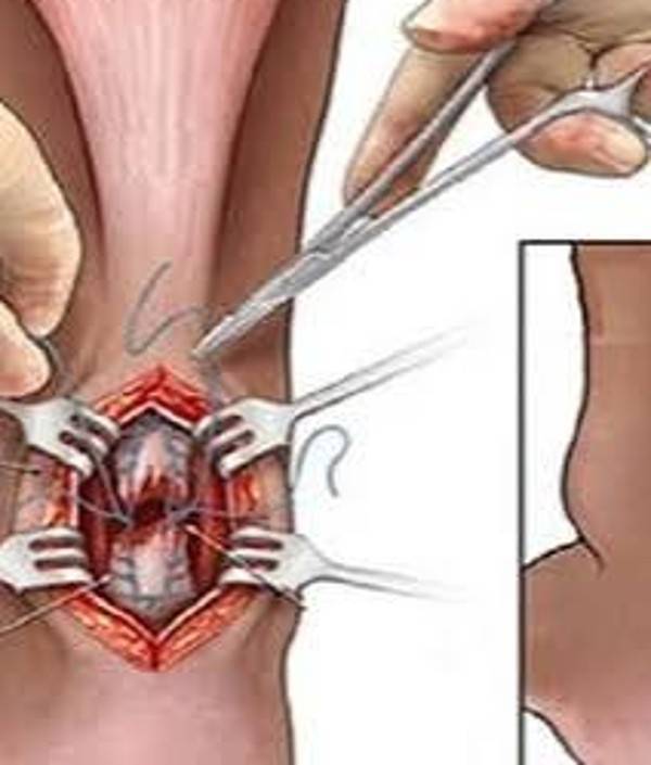 Illustration chirurgicale de la suture du tendon d'Achille