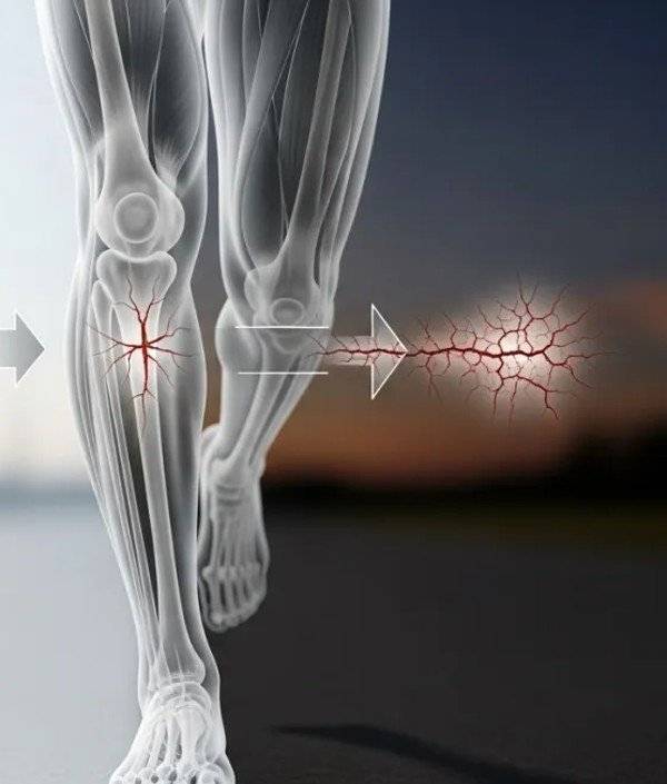 Illustration anatomique d'une fracture de fatigue au tibia
